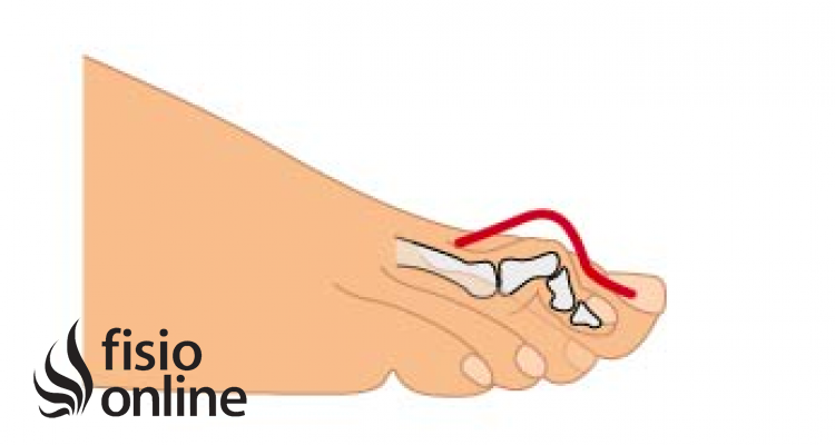 dolor linear unit solfa syllable término de un dedo del pie